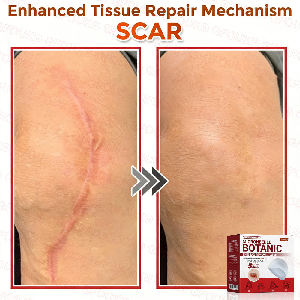 GFOUK® Soluble Microneedle Botanical Skin Tag Removal Patch🌷