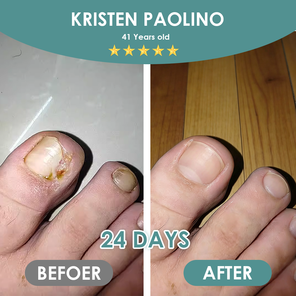 Made and Shipped from USA ✨GFOUK® Nail Fungus Laser Therapy Device