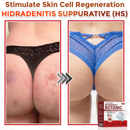 GFOUK® Soluble Microneedle Botanical Skin Tag Removal Patch🌷