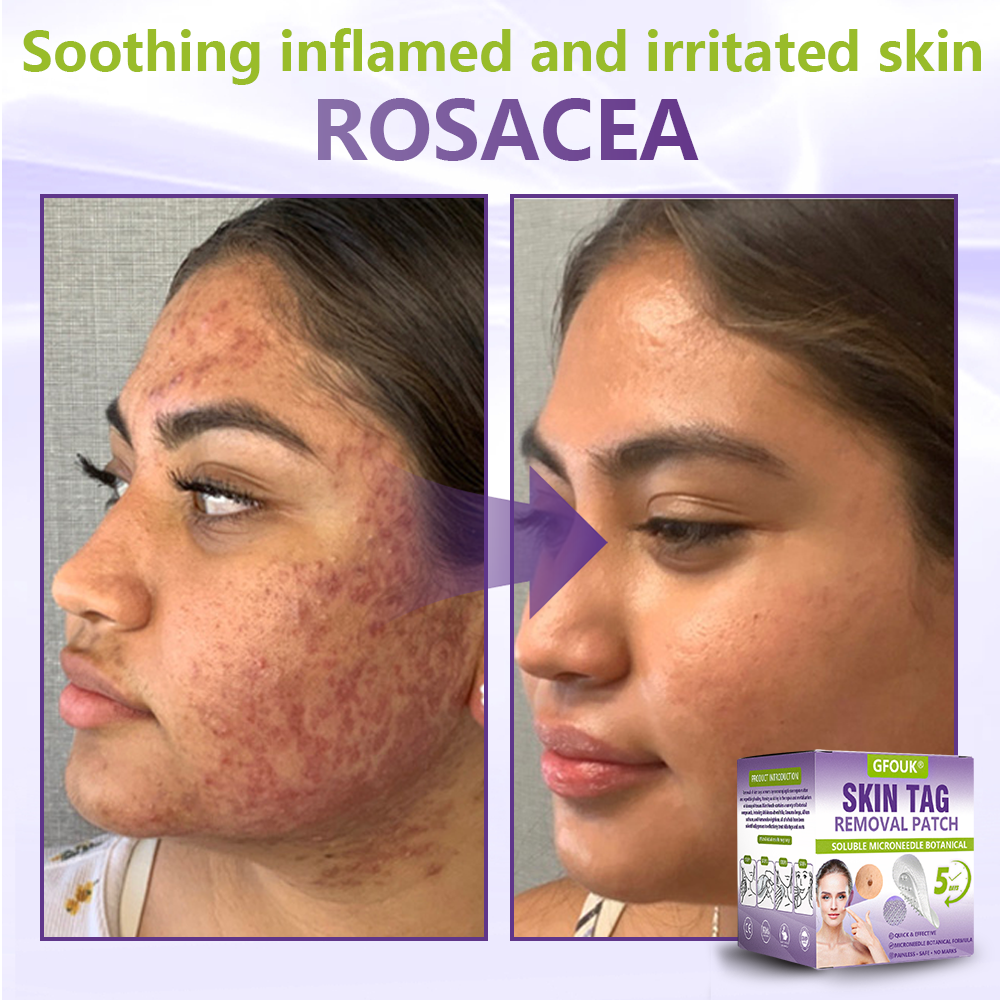 GFOUK® Soluble Microneedle Botanical Skin Tag Removal Patch🍀🍀