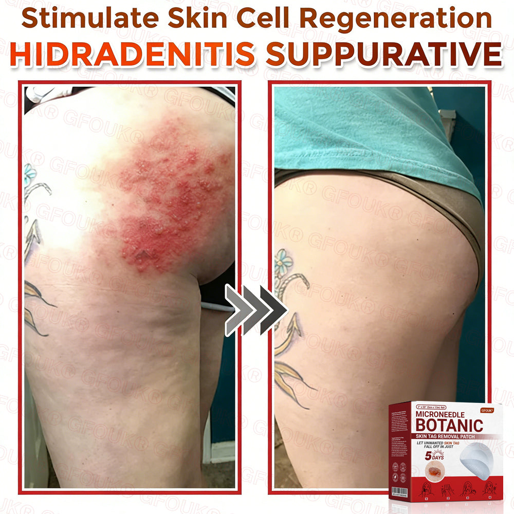 GFOUK® Soluble Microneedle Botanical Skin Tag Removal Patch🌷