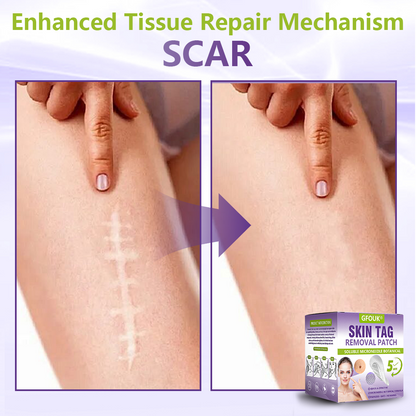 GFOUK® Soluble Microneedle Botanical Skin Tag Removal Patch🍀🍀