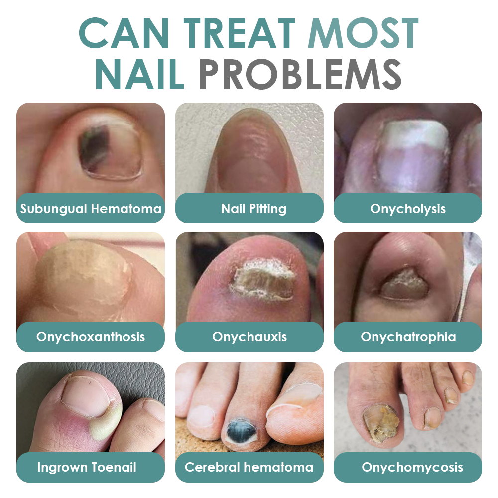 Made and Shipped from USA ✨GFOUK® Nail Fungus Laser Therapy Device