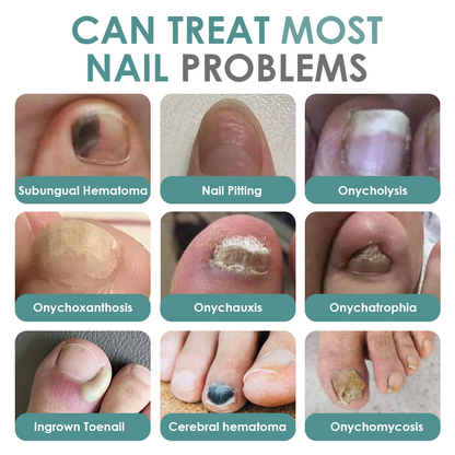 Made and Shipped from USA ✨GFOUK® Nail Fungus Laser Therapy Device