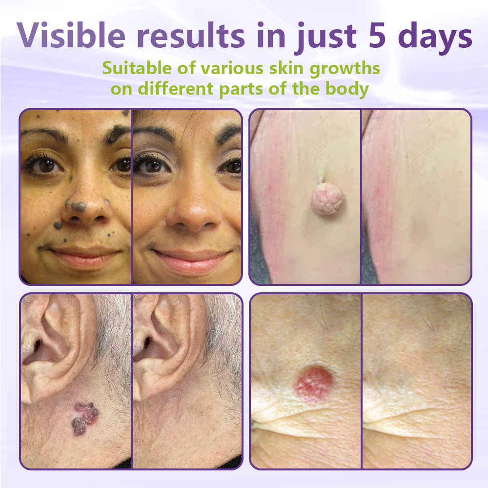 GFOUK® Soluble Microneedle Botanical Skin Tag Removal Patch🍀🍀