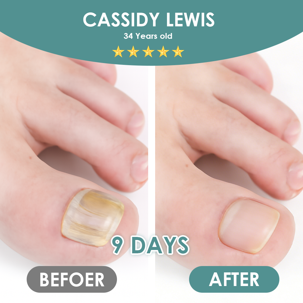 Made and Shipped from USA ✨GFOUK® Nail Fungus Laser Therapy Device