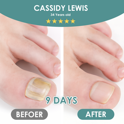 Made and Shipped from USA ✨GFOUK® Nail Fungus Laser Therapy Device
