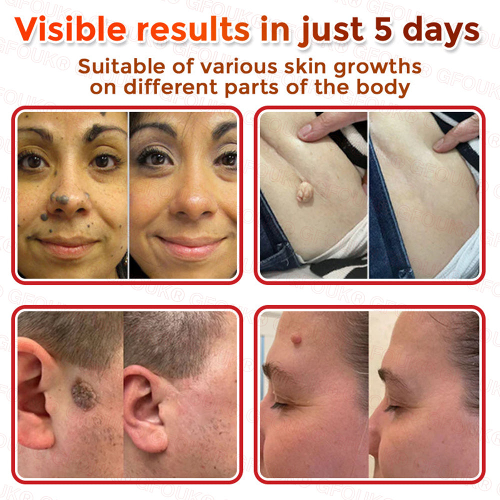 GFOUK® Soluble Microneedle Botanical Skin Tag Removal Patch🌷