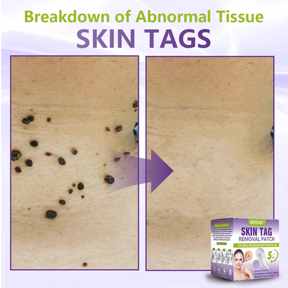 GFOUK® Soluble Microneedle Botanical Skin Tag Removal Patch🍀🍀