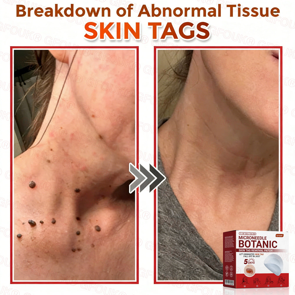GFOUK® Soluble Microneedle Botanical Skin Tag Removal Patch🌷