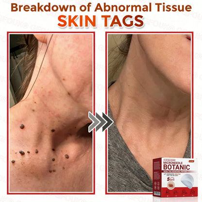 GFOUK® Soluble Microneedle Botanical Skin Tag Removal Patch🌷