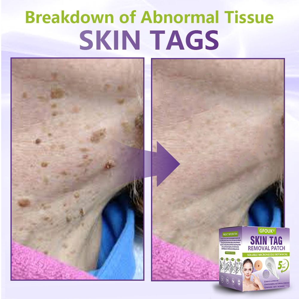 GFOUK® Soluble Microneedle Botanical Skin Tag Removal Patch🍀🍀
