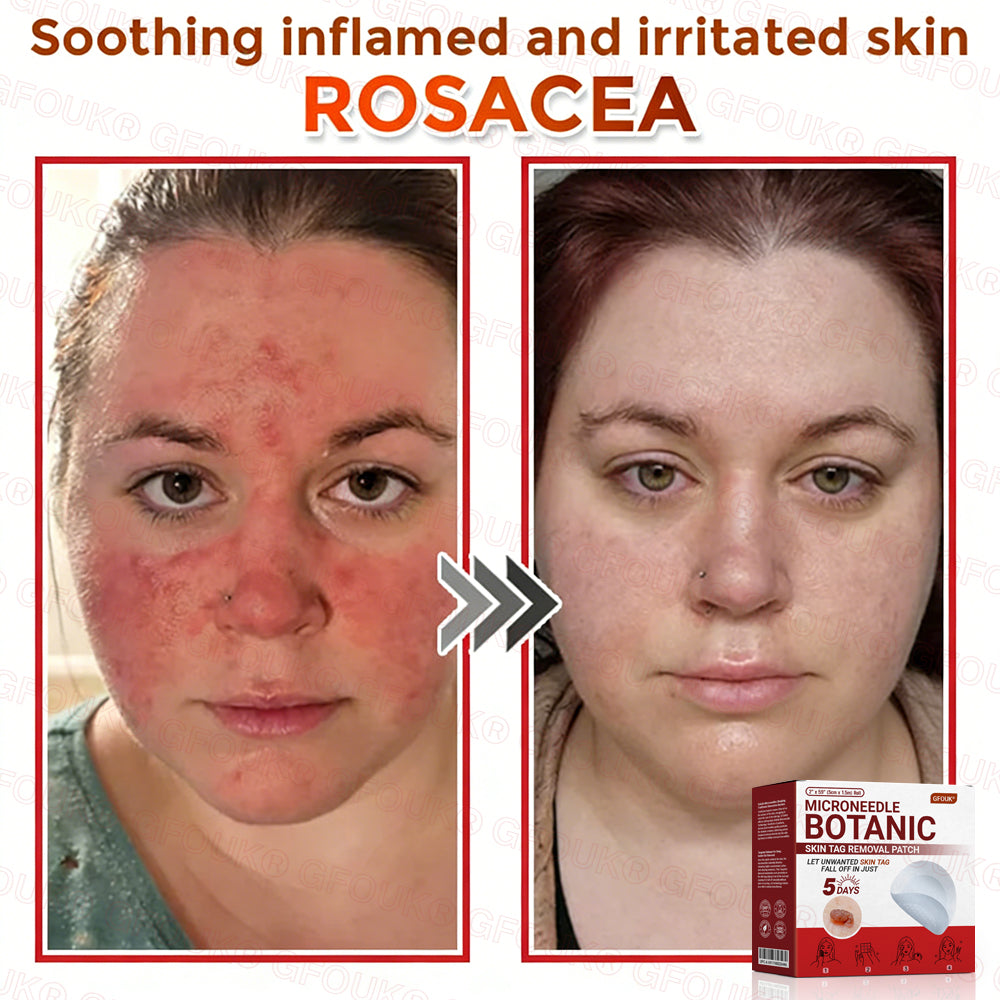 GFOUK® Soluble Microneedle Botanical Skin Tag Removal Patch🌷