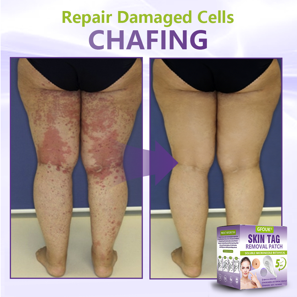 GFOUK® Soluble Microneedle Botanical Skin Tag Removal Patch🍀🍀