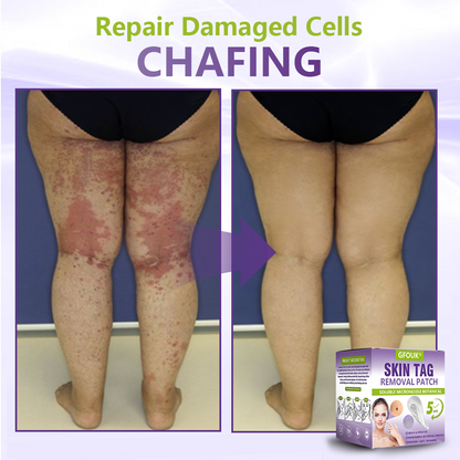 GFOUK® Soluble Microneedle Botanical Skin Tag Removal Patch🍀🍀