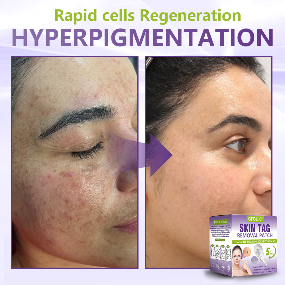 GFOUK® Soluble Microneedle Botanical Skin Tag Removal Patch🍀🍀