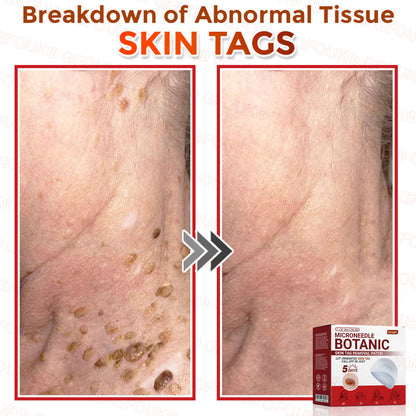 GFOUK® Soluble Microneedle Botanical Skin Tag Removal Patch🌷