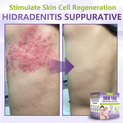 GFOUK® Soluble Microneedle Botanical Skin Tag Removal Patch🍀🍀