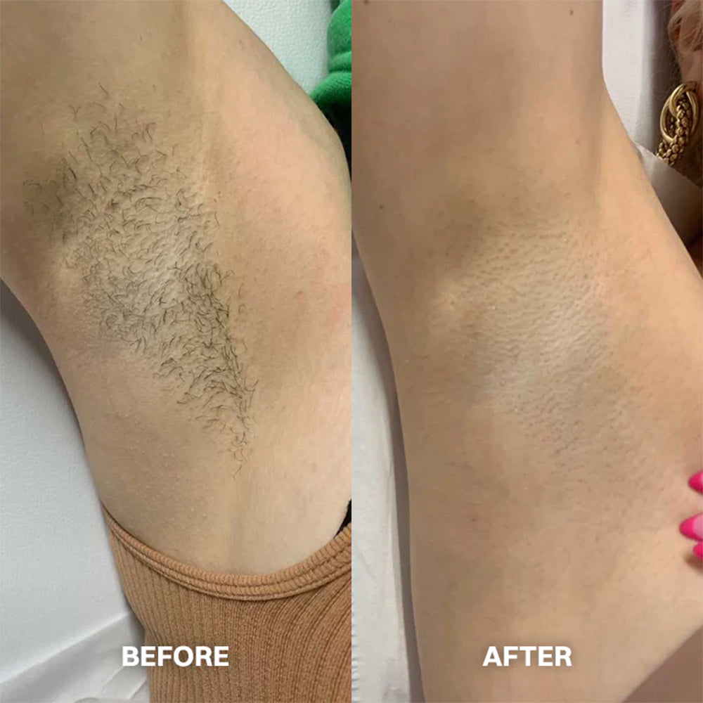 Hair Removal Cream for All Women & Men -up