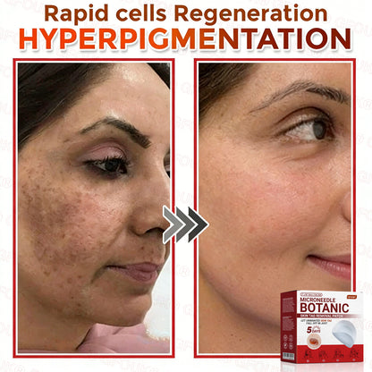 GFOUK® Soluble Microneedle Botanical Skin Tag Removal Patch🌷