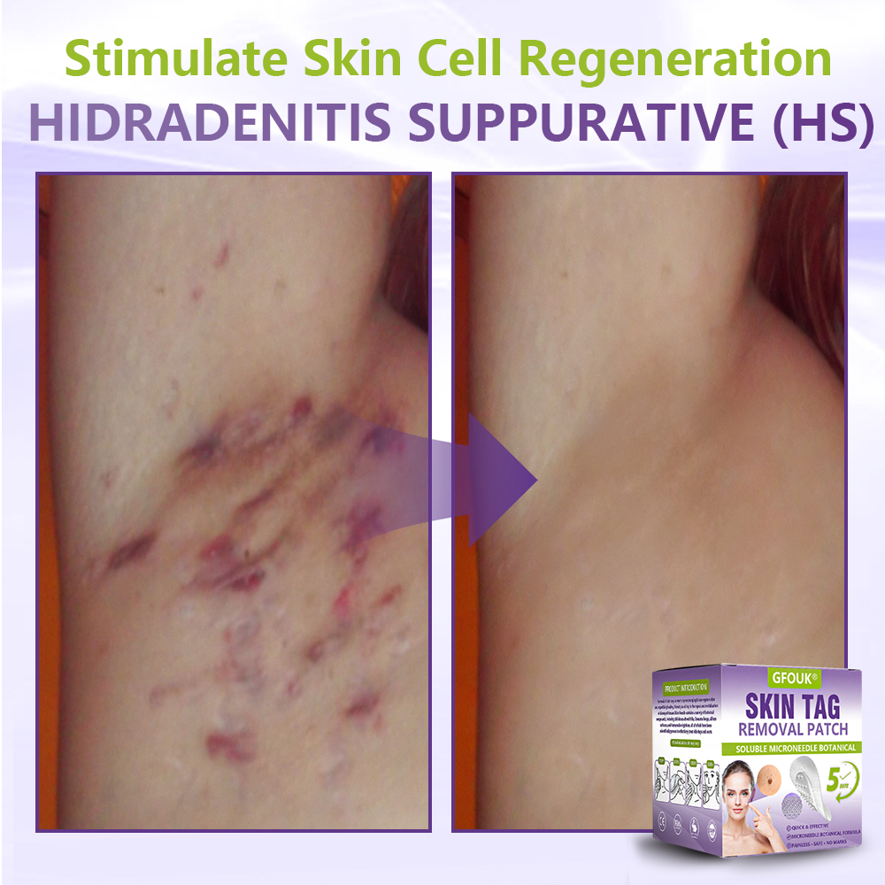 GFOUK® Soluble Microneedle Botanical Skin Tag Removal Patch🍀🍀